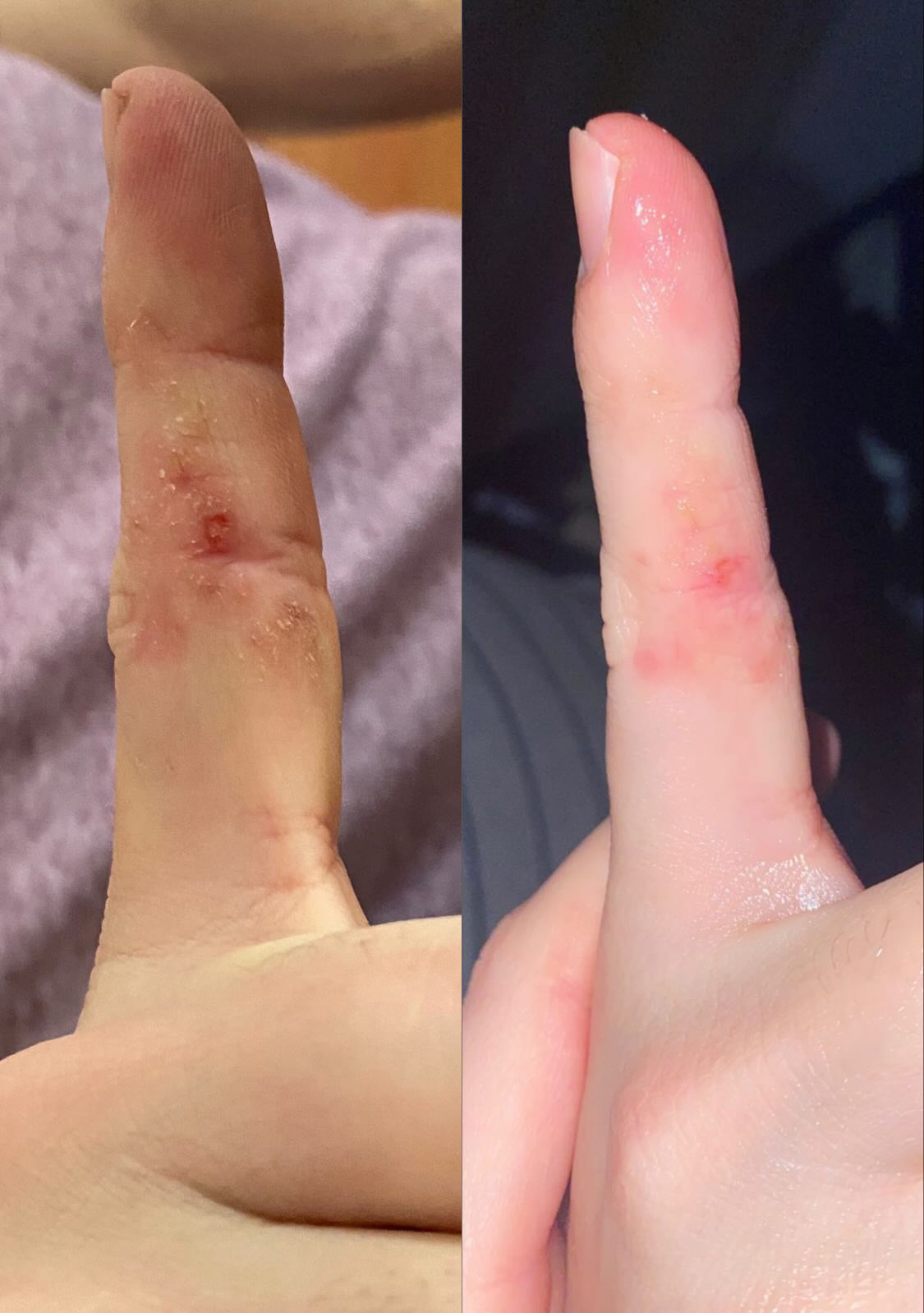 customer review on soothing balm finger with rash progress photo after use of soothing balm improvement of rash